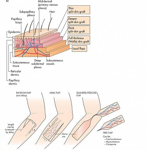 Flaps Vs Grafts Differences Between Grafts And Flaps In Medicine