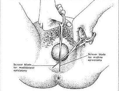 Episiotomy Meaning, Types of Episiotomy, Indications ... perineum diagram canal 